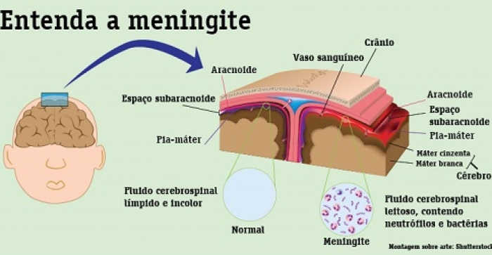 Caso de meningite preocupa Três Coroas